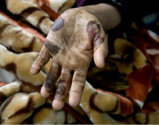 21.12.09, gaza-white-phosphorus-wound. richardsilverstein.com, JPEG Gaza, salah satu dampak bom fosfor (foto: richardsilverstein.com)