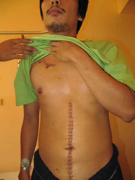 Bekas operasi dada dan perut Surya Fachrizal. Foto: Dzikrullah/Sahabat Al-Aqsha