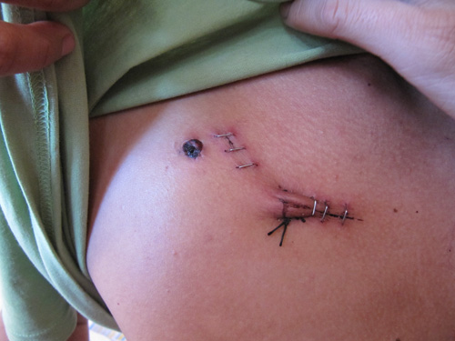 Lubang masuk dan sayatan untuk tube keluar darah Surya Fachrizal. Foto: Dzikrullah/Sahabat Al-Aqsha