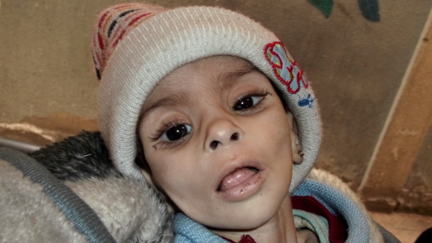 Israa al-Masri, bayi Palestina di kamp Yarmouk yang meninggal karena kelaparan pada 11 Januari 2014. Untuk pertama kalinya, bantuan makanan berhasil masuk ke kamp Yarmouk setelah dikepung sejak Oktober 2013. Foto: Palestinians of Syria/Associated Press