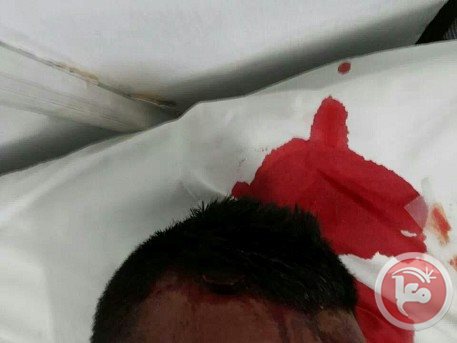 Seorang jama'ah yang terluka akibat serangan pasukan penjajah zionis ke komplek Masjidil Aqsha kemarin. foto: Maan News