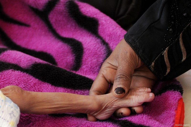 Seorang bayi yang menderita malnutrisi mendapat perawatan medis di RS Al Sabeen, Sanaa, Yaman. Foto: Mohammed Hamoud/Anadolu Agency 